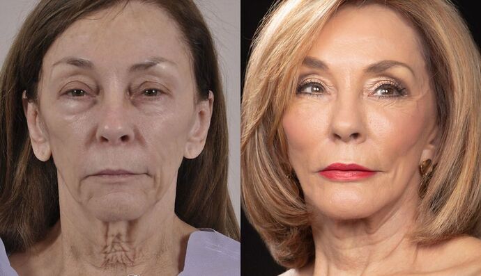 Eyelid Surgery: Case 18 - Before and After