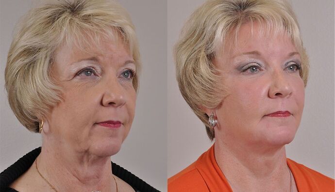 Eyelid Surgery: Case 20 - Before and After
