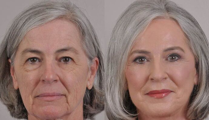 Eyelid Surgery: Case 22 - Before and After