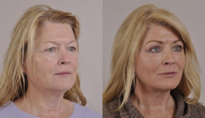Eyelid Surgery: Case 23 - Before and After