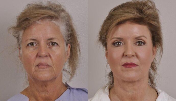 Eyelid Surgery: Case 25 - Before and After