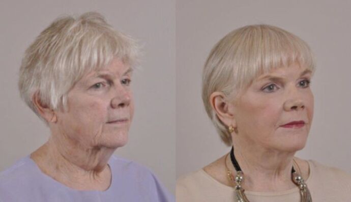 Eyelid Surgery: Case 26 - Before and After