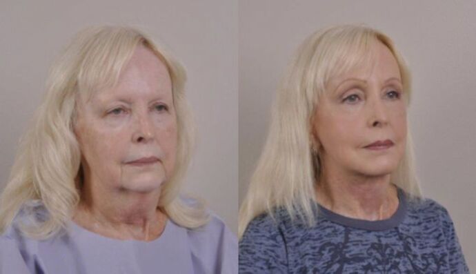 Eyelid Surgery: Case 28 - Before and After