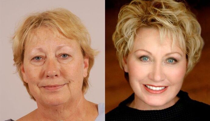 Eyelid Surgery: Case 29 - Before and After