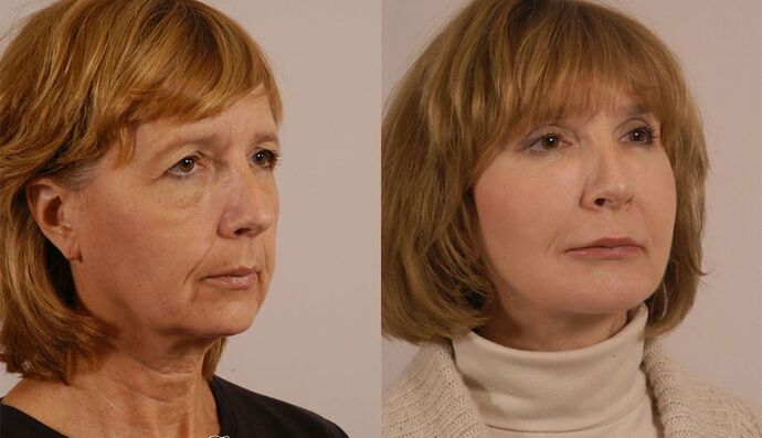 Eyelid Surgery: Case 30 - Before and After