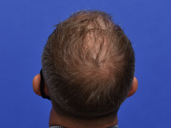 Hair Restoration: Case 1 - Before