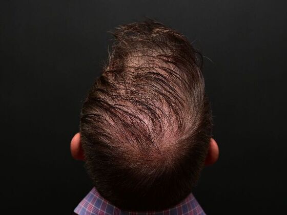 Hair Restoration: Case 1 - After