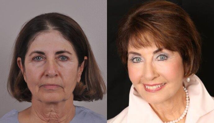 Eyelid Surgery: Case 31 - Before and After