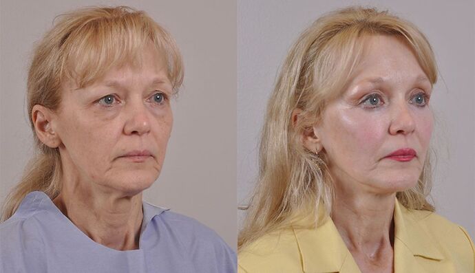 Eyelid Surgery: Case 34 - Before and After