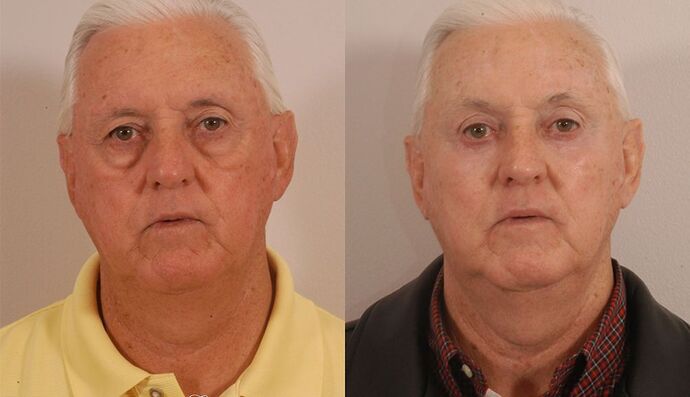 Eyelid Surgery: Case 37 - Before and After