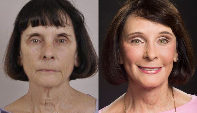 Eyelid Surgery: Case 48 - Before and After