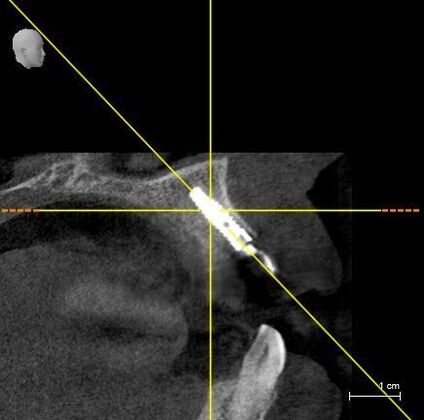 Dental Implants: Immediate Placement and Temporary - Before