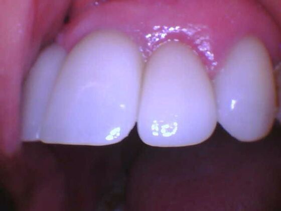 Dental Implants: Immediate Placement and Temporary - Before