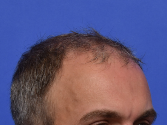 Hair Restoration: Case 1 - Before