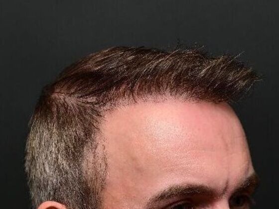 Hair Restoration: Case 1 - After