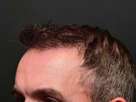 Hair Restoration: Case 1 - After