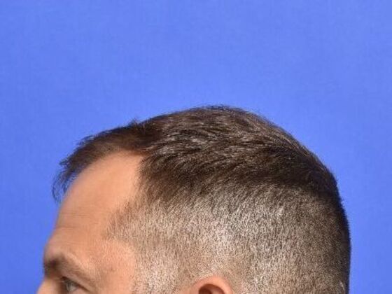 Hair Restoration: Case 2 - Before