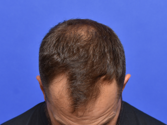 Hair Restoration: Case 2 - Before