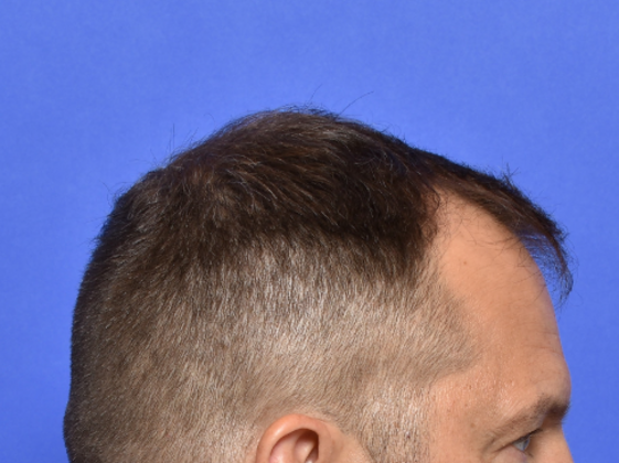 Hair Restoration: Case 2 - Before