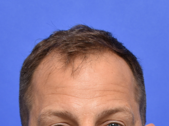 Hair Restoration Case 2 - Before