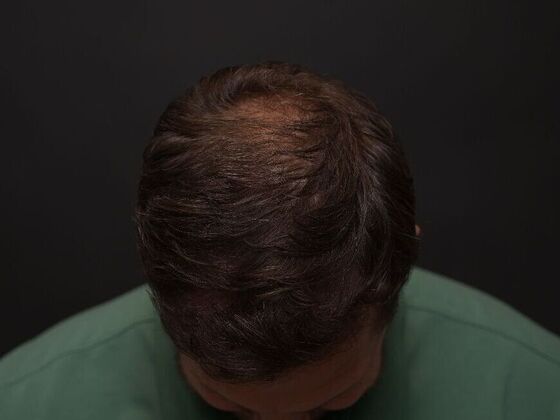 Hair Restoration: Case 2 - After