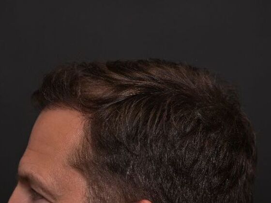 Hair Restoration: Case 2 - After