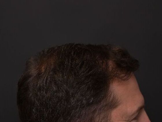 Hair Restoration: Case 2 - After