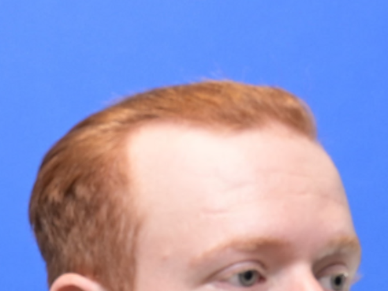 Hair Restoration: Case 3 - Before