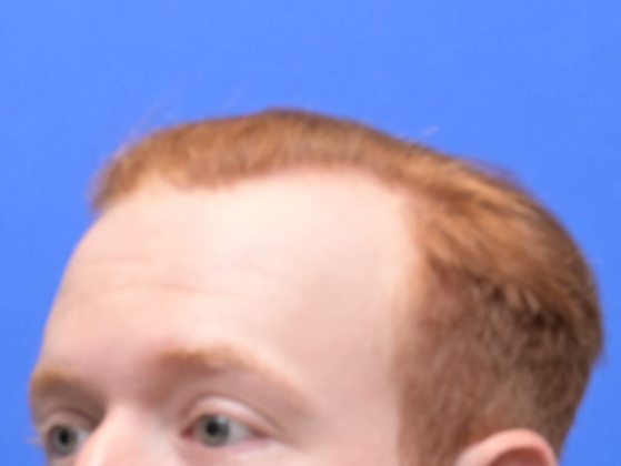 Hair Restoration: Case 3 - Before