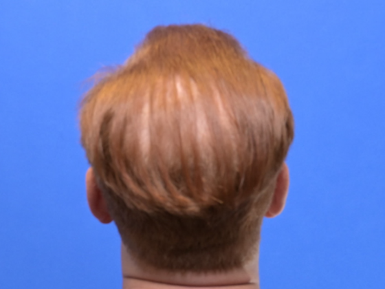 Hair Restoration: Case 3 - Before