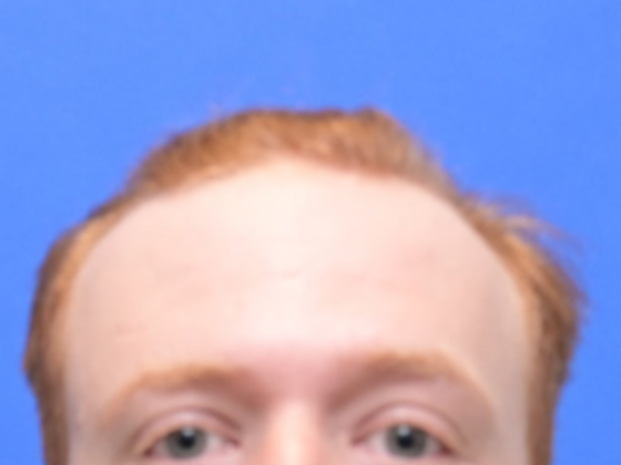 Hair Restoration Case 3 - Before