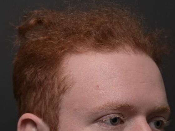 Hair Restoration: Case 3 - After