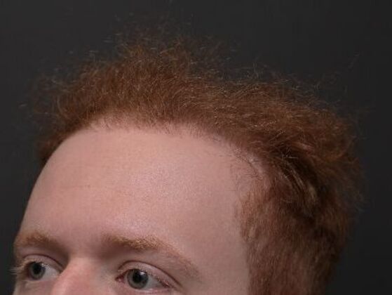 Hair Restoration: Case 3 - After