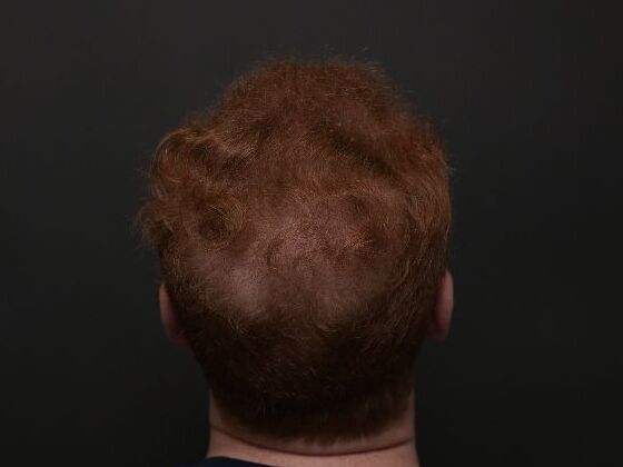 Hair Restoration: Case 3 - After