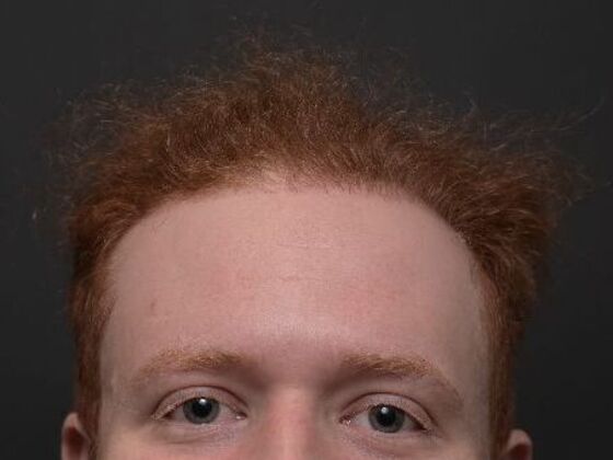 Hair Restoration Case 3 - After