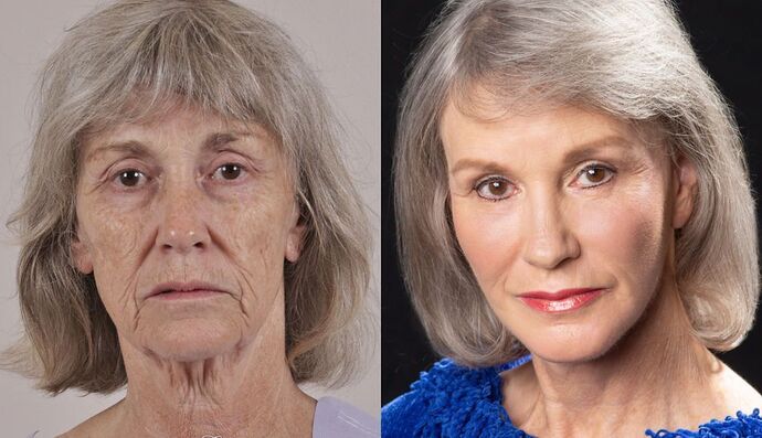 Chin Augmentation/Implant Case 12