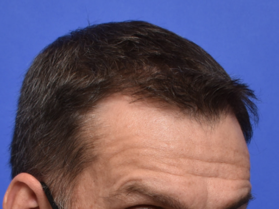 Hair Restoration: Case 4 - Before