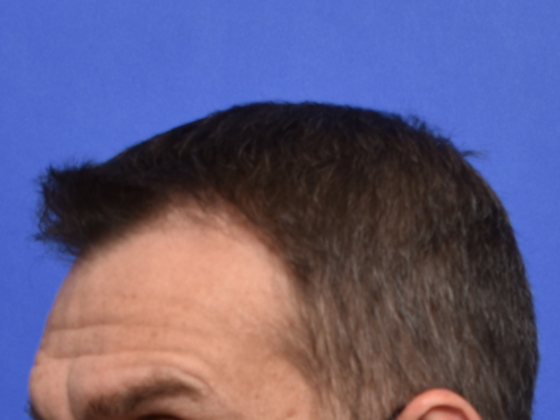 Hair Restoration: Case 4 - Before