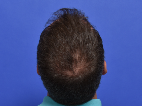 Hair Restoration: Case 4 - Before