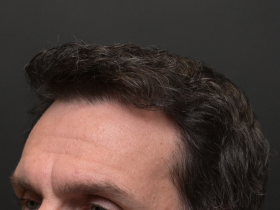 Hair Restoration: Case 4 - After