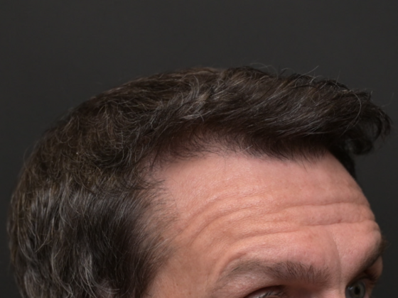 Hair Restoration: Case 4 - After