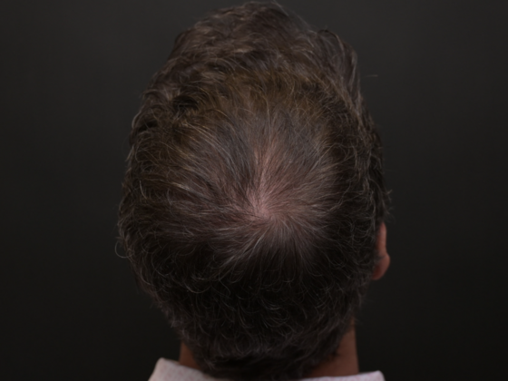 Hair Restoration: Case 4 - After