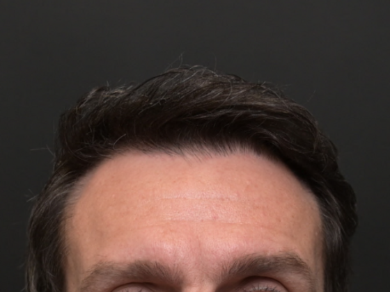 Hair Restoration Case 4 - After