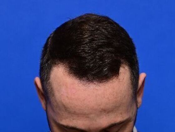 Hair Restoration: Case 5 - Before