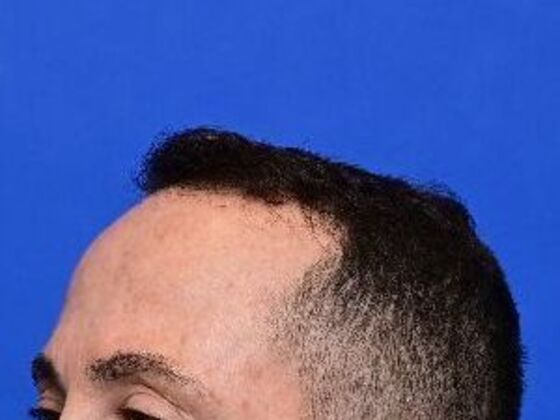 Hair Restoration: Case 5 - Before