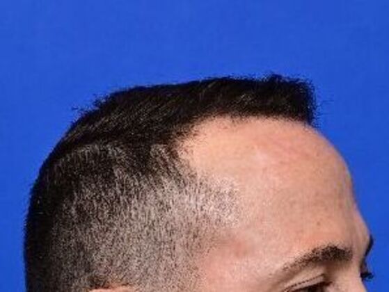 Hair Restoration: Case 5 - Before