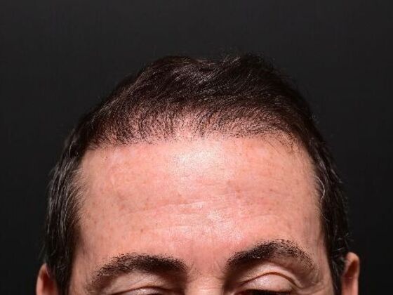 Hair Restoration Case 5 - After