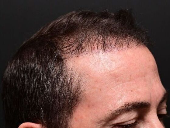 Hair Restoration: Case 5 - After