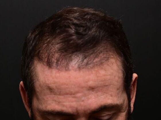 Hair Restoration: Case 5 - After