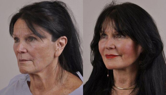 Facial Liposuction: Case 35 - Before and After